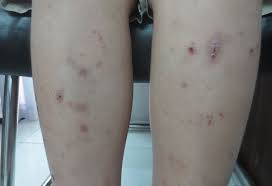 Nhiễm giun sán - Hình ảnh minh họa